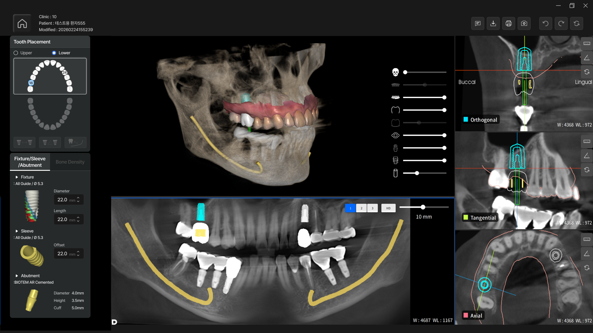 3D 데이터를 기반으로 빠르고 정밀한 임플란트 계획이 가능합니다.
